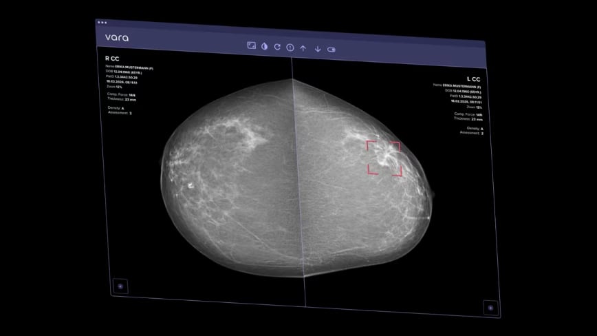 AI Can Now Clear Some Mammograms Without a Radiologist’s Review